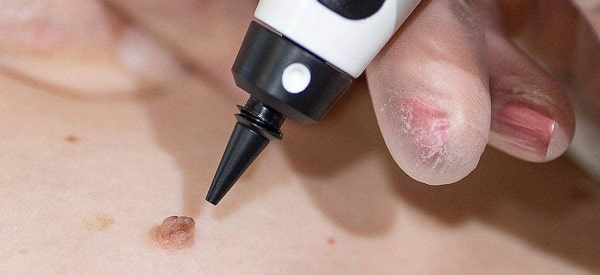 After Skin Tag Removal Ponders End