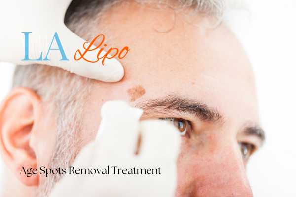 What Are the Most Effective Treatments for Age Spots Ponders End?