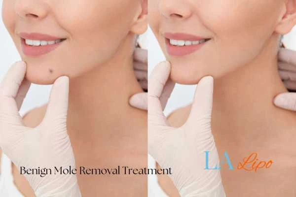 Before-and-after results following benign mole-removal treatment Ponders End
