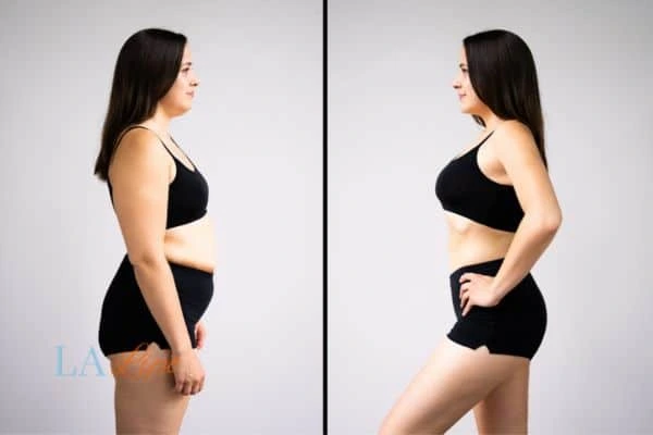 image of woman before and after results of LA-EMS Body Sculpting Ponders End to help treat Diastasis recti