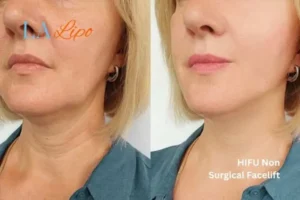 hi-fu for wrinkles Ponders End before and after results