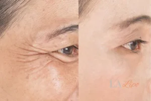 Before and after results of woman - HI-fu wrinkles reduction treatment Ponders End