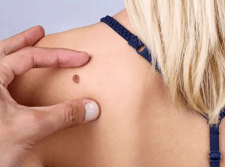 woman having mole removal Ponders End consultation before treatment.