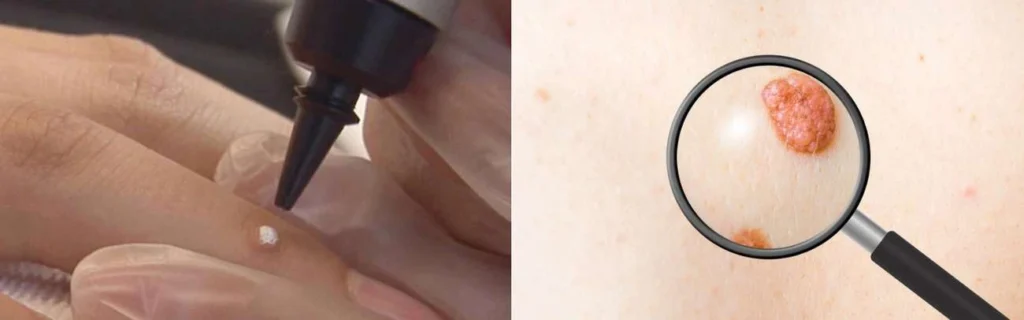 CryoPen practitioner Ponders End assessing a benign mole before treatment