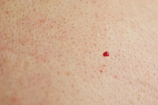 close up of a cherry angioma Ponders End