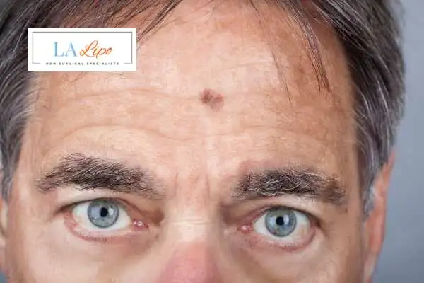 Solar Lentigo Removal Ponders End image of man with mark on his forehead