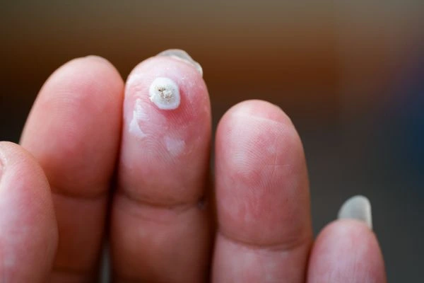 wart on person finger - cryotherapy to treat from LA LIPO Ponders End