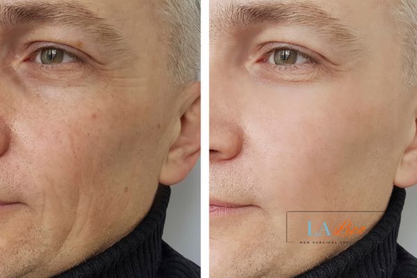 See the amazing results of Morpheus8 Treatment Ponders End!