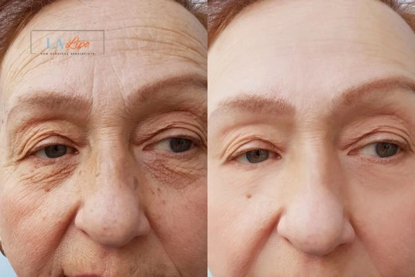 The powerful benefits of Morpheus8 Treatment Ponders End - Call Our team today!