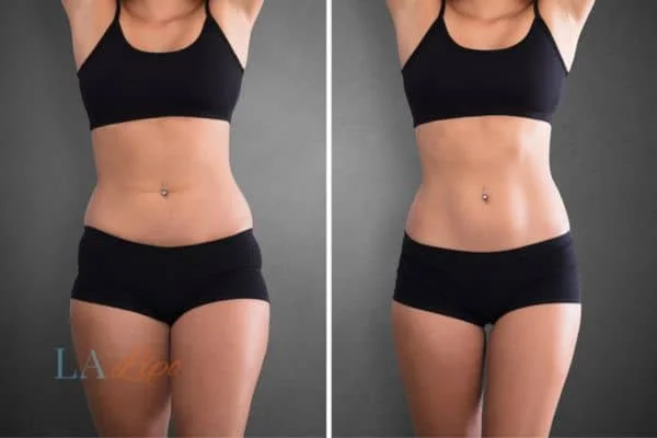 before and after results of non-surgical treatment to help a woman's body image and mental health Ponders End