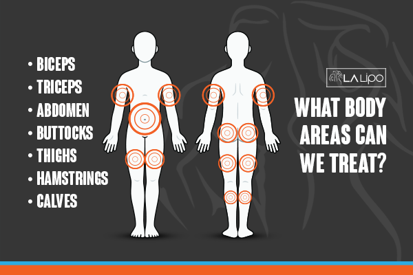 Diagram to show areas you can have LA-EMS Body Sculpting Treatment Ponders End