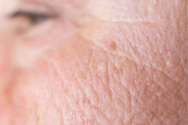 close up picture of a woman's face showing an age spot Ponders End
