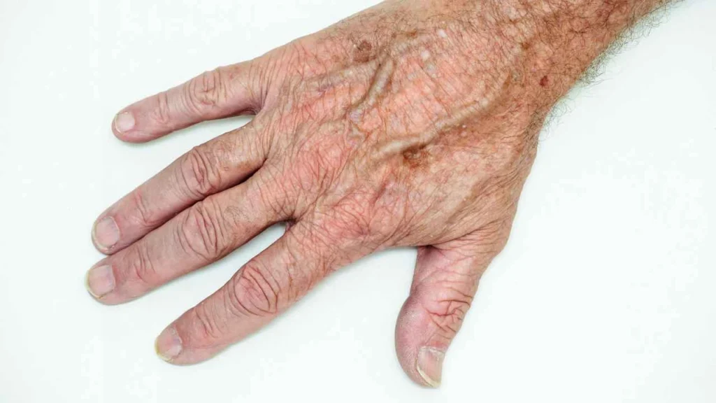 Male hand showing age spot Ponders End