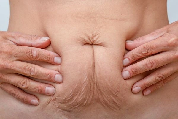 Image of a woman's stomach with loose skin - example of skin tightening Ponders End options
