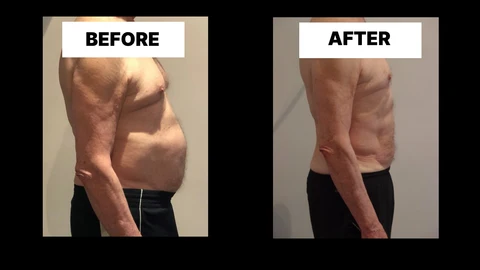 What Symptoms Can Diastasis Recti Cause in Men? Weak Core, Back Pain and Poor Posture Ponders End